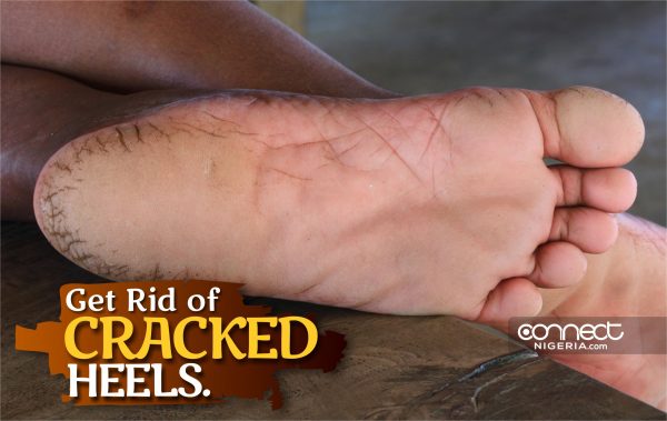 Get Rid of Cracked Heels