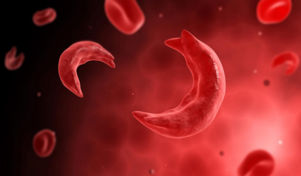 Sickle Cell